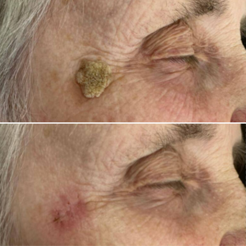 Lumévia™ | Pigmentkorrigerande Serum för Jämnare Hudton