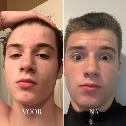 Dedoza Blackhead Remover