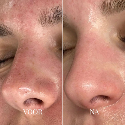 Dedoza Blackhead Remover