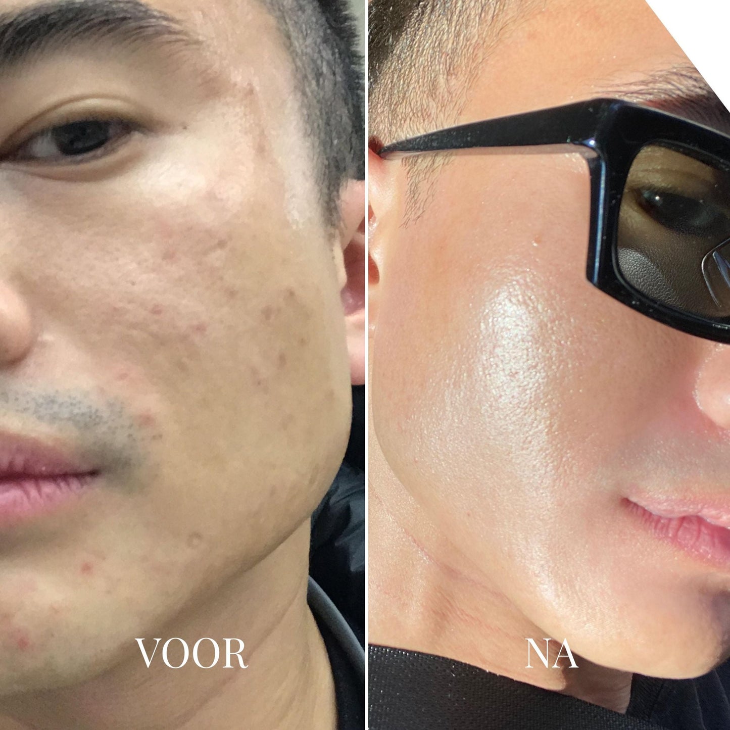 Dedoza Blackhead Remover