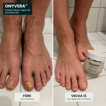 Onyvera™ | Synligt friskare naglar på ett enkelt sätt