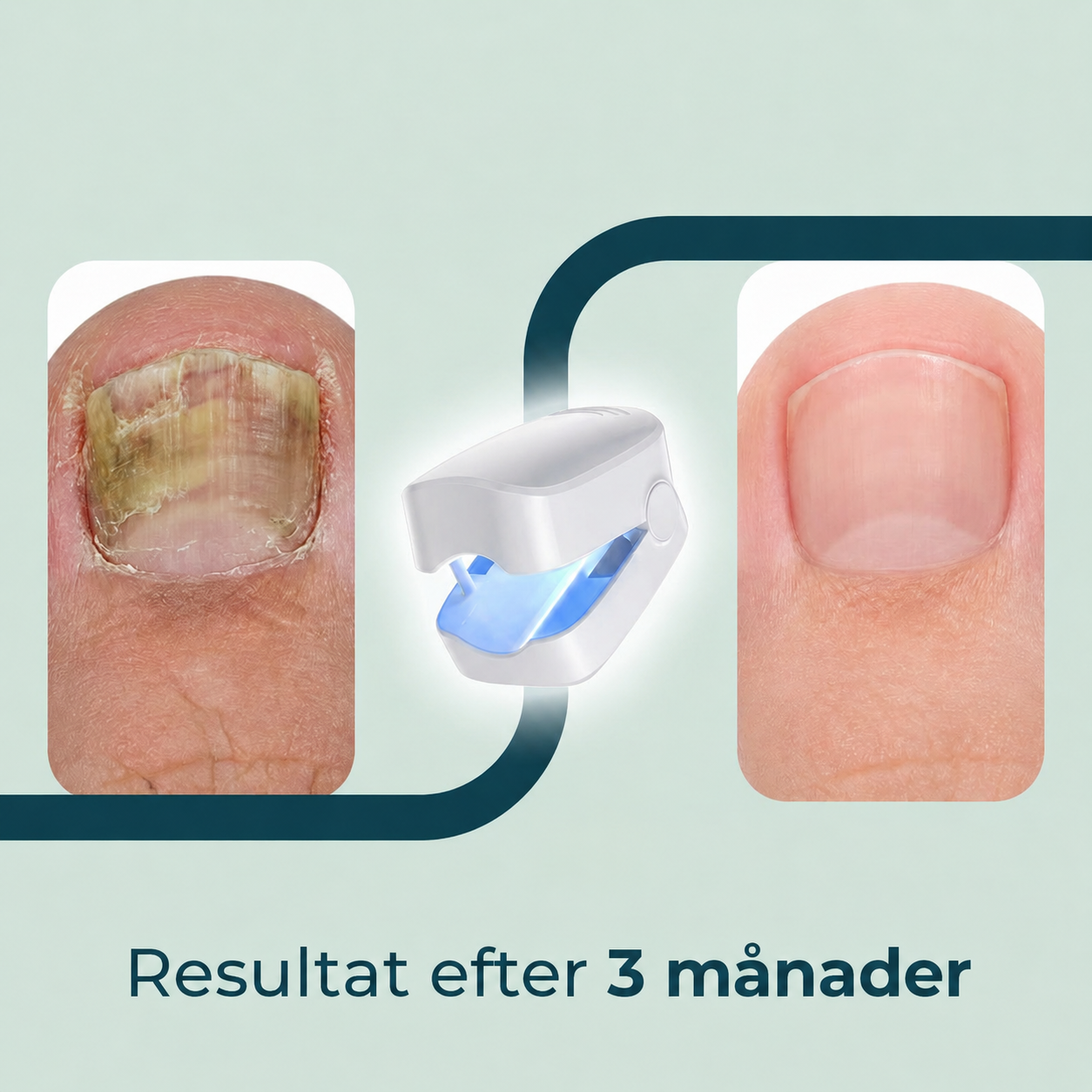 Nailuma™ | Ljusvård för klarare och mer välvårdade naglar – på bara 7 minuter om dagen