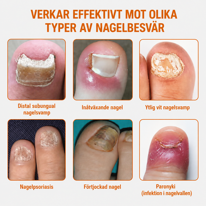 Mycova™ | Tar bort nagelsvamp och återställer friska naglar