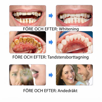 Denvia™ – Ultraljudsrengöring för tänderna