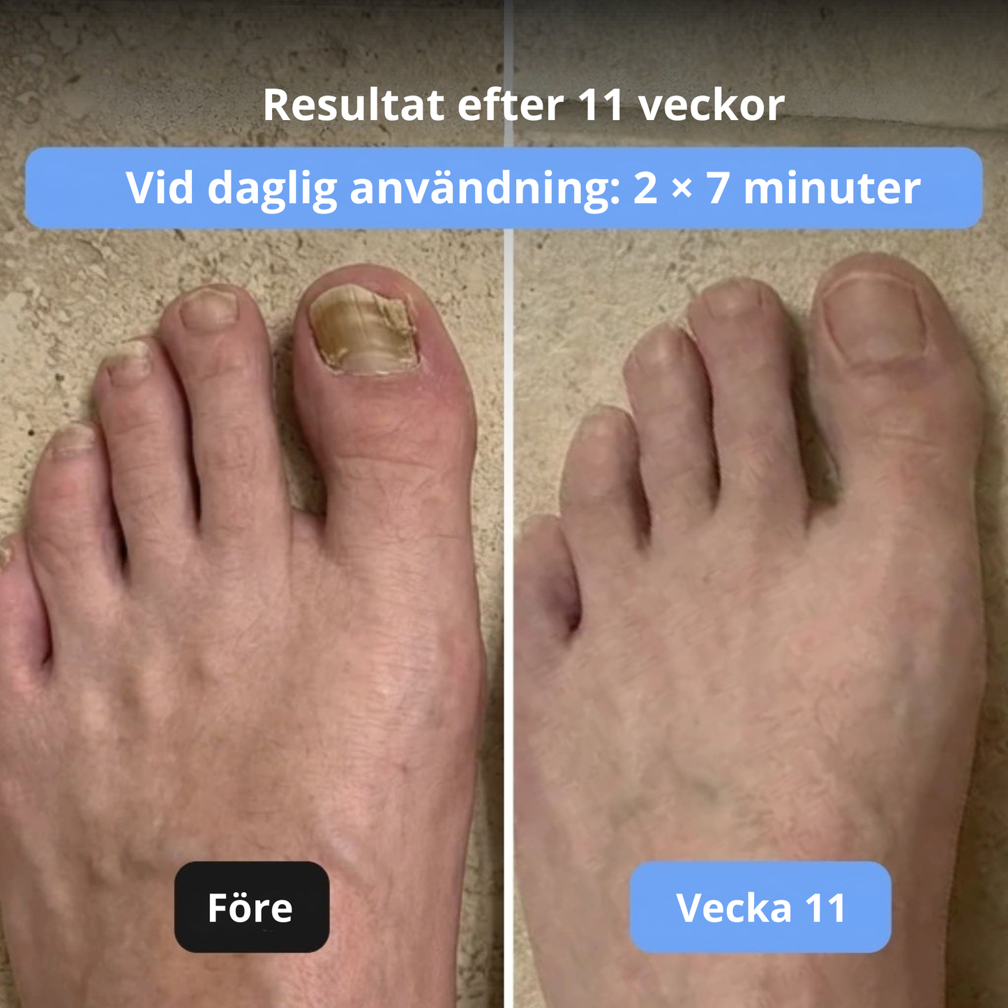 DedoClear™ – Avancerad 3-i-1-terapiapparat