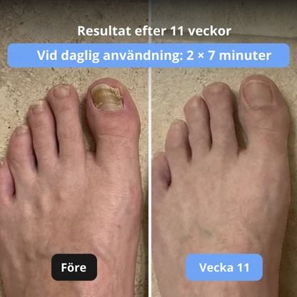 DedoClear™ – Avancerad 3-i-1-terapiapparat