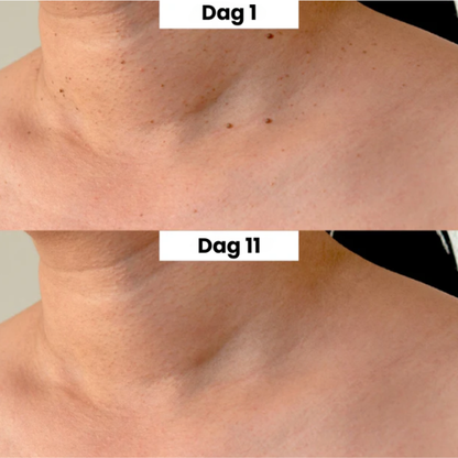 Skinvera™ | Skintag Remover Pen – Ta Bort Hudflikar Snabbt & Enkelt Hemma