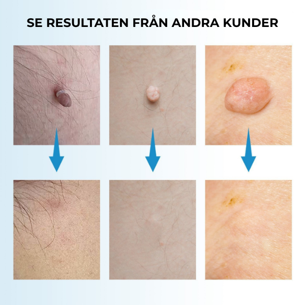 Skinvera™ | Skintag Remover Pen – Ta Bort Hudflikar Snabbt & Enkelt Hemma