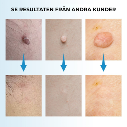 Skinvera™ | Skintag Remover Pen – Ta Bort Hudflikar Snabbt & Enkelt Hemma